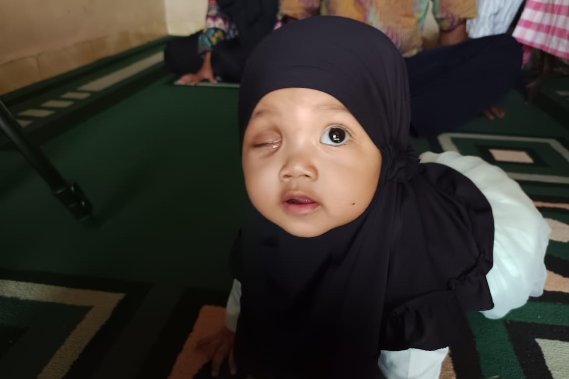 Mensos Berikan Bantuan untuk Bayi Suci Penderita Tumor di Mata